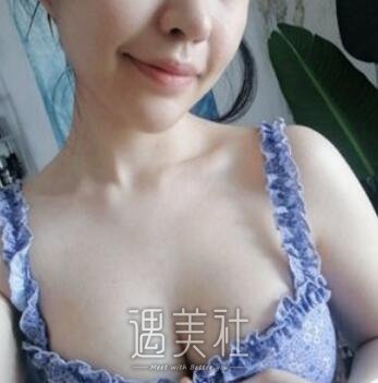 刘成胜,丰胸