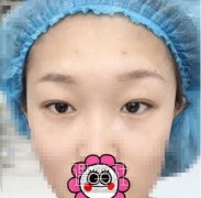 汕头华美朱洙玉双眼皮+隆鼻案例：医院医生选对很重要啊！ width=