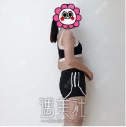 大连新华美天王建大腿溶脂术公布：瘦了5cm，亲身果图分享~ width=