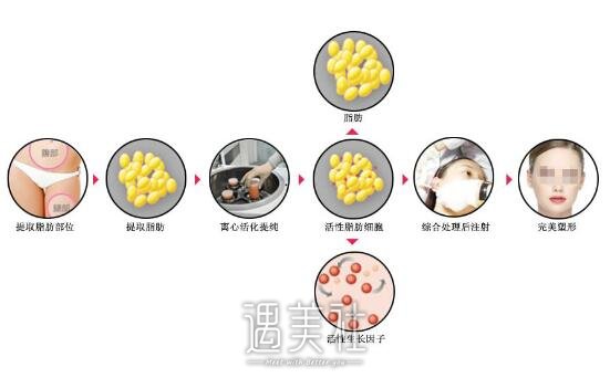 芜湖壹加壹整形医院怎么样?面部脂肪填充果如何?