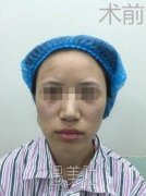 南宁美丽焦点整形医院正规吗?做面部脂肪填充果如何? width=