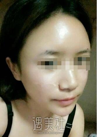 南宁美丽焦点整形医院正规吗?做面部脂肪填充果如何?