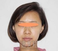 范飞隆鼻案例：一个鼻子美死一张脸呐！ width=