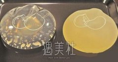 假体隆胸材料该怎么选择，哪种材料比较好？ width=