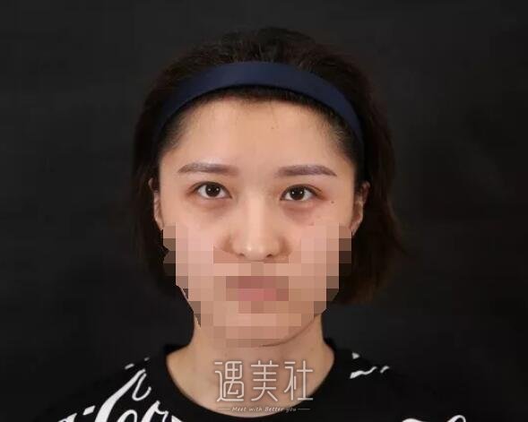 永康美莱整形医院做隆鼻项目果如何?我想摆脱现状~