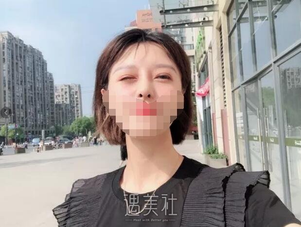 永康美莱整形医院做隆鼻项目果如何?我想摆脱现状~