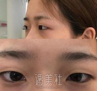 杨杰双眼皮案例分享，大眼睛才是真的美~ width=