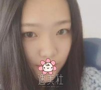 周柯隆鼻案例：这鼻部轮廓看了谁能不心动？ width=