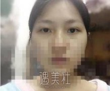 靳小雷双眼皮案例：真实恢复过程+图片分享 width=