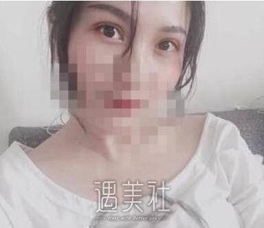 靳小雷,双眼皮