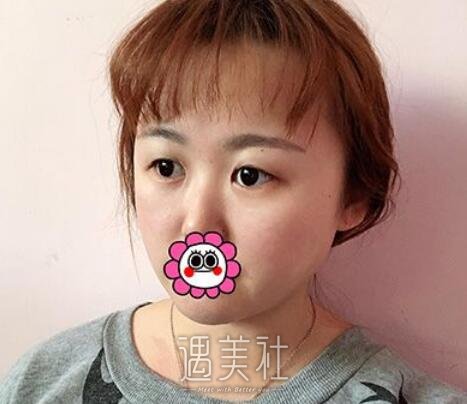 薛志强,双眼皮