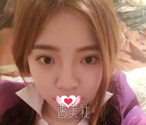 王涛,隆鼻