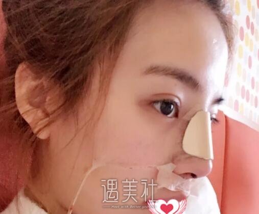 王涛,隆鼻