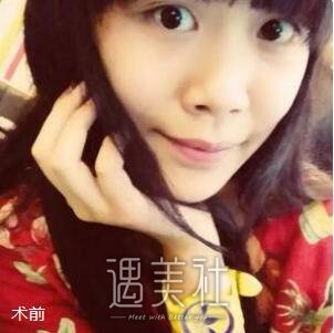 胡凯,隆鼻