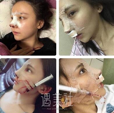 胡凯,隆鼻