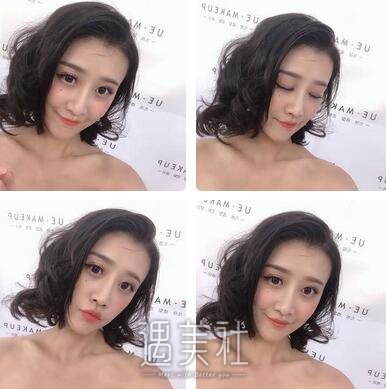 胡凯,隆鼻