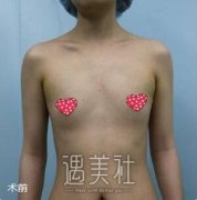 八大处栾杰丰胸案例 做了有100天了我来说两句 width=