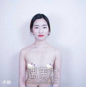 张立彬,脂肪丰胸