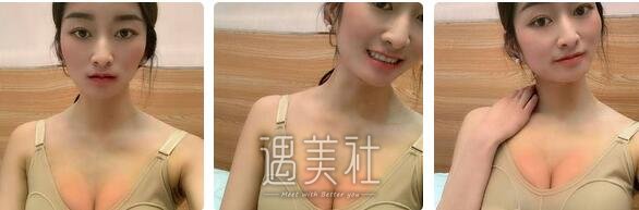张立彬,脂肪丰胸