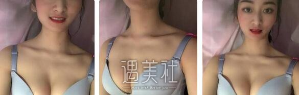 张立彬,脂肪丰胸