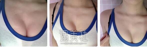 张立彬,脂肪丰胸