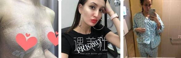 程晓林,丰胸