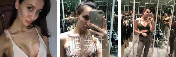 程晓林,丰胸