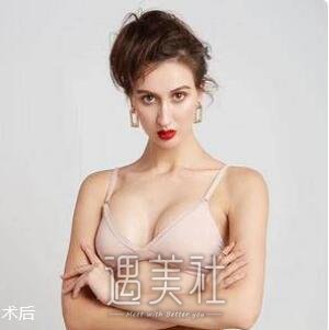 程晓林,丰胸