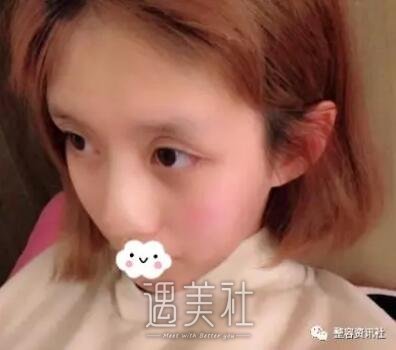 哈尔滨艺星整形医院隆鼻技术好不好?真实案例及果图分享~