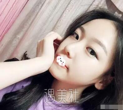 哈尔滨艺星整形医院隆鼻技术好不好?真实案例及果图分享~