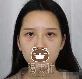宿州天使整形医院双眼皮技术如何?案例及价目表一览~