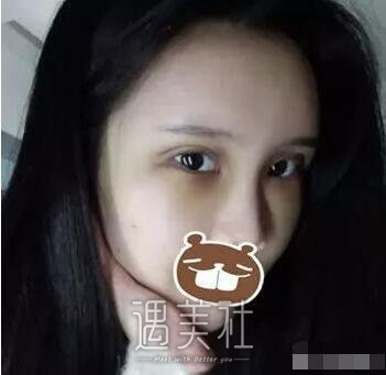 宿州天使整形医院双眼皮技术如何?案例及价目表一览~