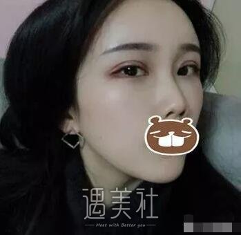 宿州天使整形医院双眼皮技术如何?案例及价目表一览~