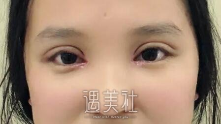 宁波悦尔整形医院做双眼皮有保障吗?案例及果图分享~