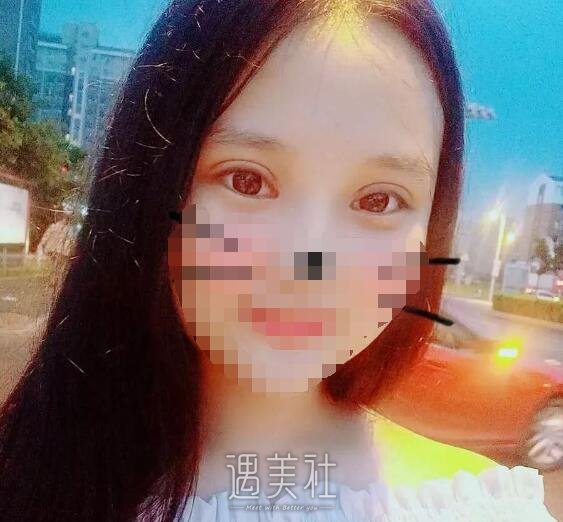 宁波悦尔整形医院做双眼皮有保障吗?案例及果图分享~