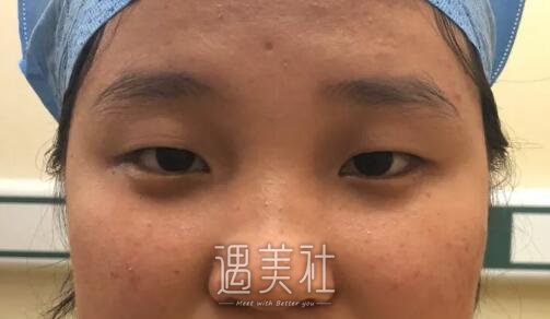 宁波悦尔整形医院做双眼皮有保障吗?案例及果图分享~