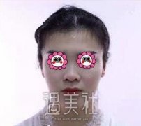 王艇隆鼻案例：鼻子挺立了，素颜也是OK的！ width=