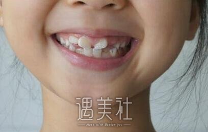 牙齿不齐