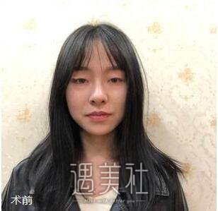 薛峰,双眼皮