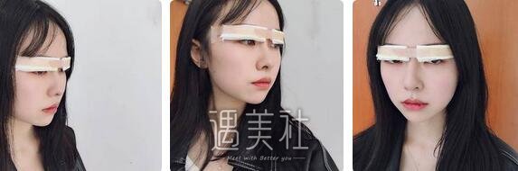 薛峰,双眼皮