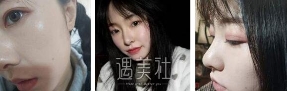 薛峰,双眼皮