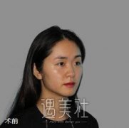 王旭明隆鼻案例：花了四万多的鼻子就是这个亚子 width=