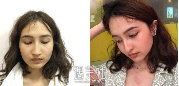 李青峰,隆鼻