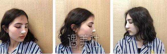 李青峰,隆鼻
