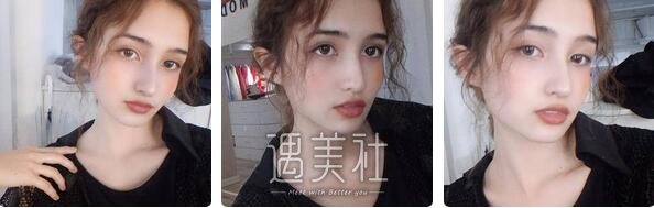 李青峰,隆鼻