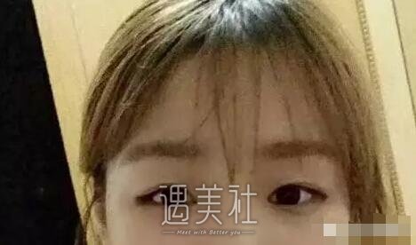 通化吴学军美容医院双眼皮技术怎么样?2020年案例及价格表一览~