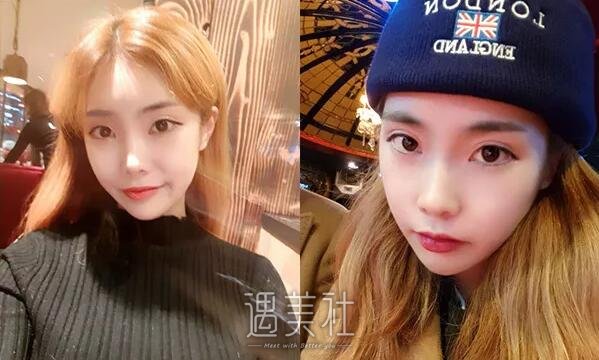 浙大二院整容科怎么样?2020年面部整形案例及价格表一览~