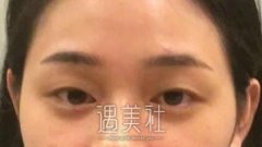 上海九院傅瑶怎么样？九院傅瑶双眼皮案例更新~ width=