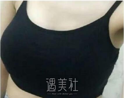 曾昂,丰胸
