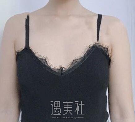王明利,自体脂肪丰胸